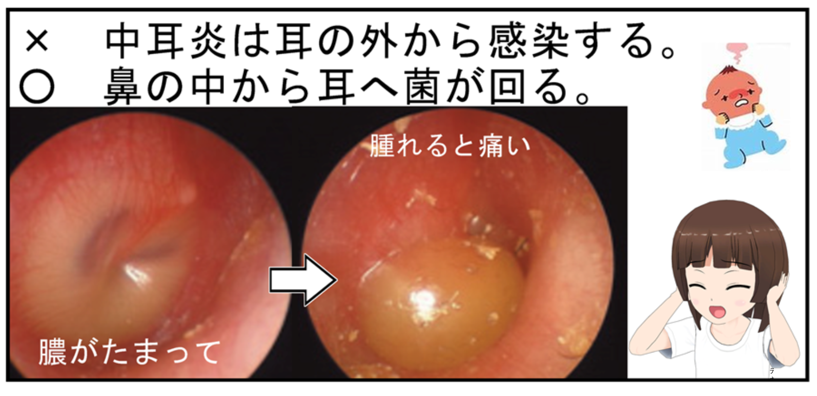 急性中耳炎
