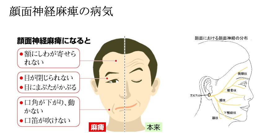 顔麻痺